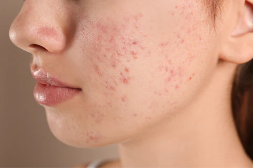 What causes acne?