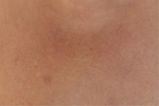 What is rosacea?